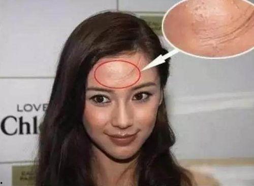 青春痘 明星,揭秘明星们的青春痘对抗秘籍